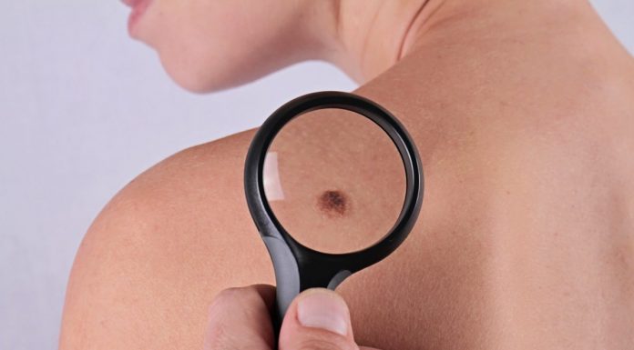 Cancerul de piele – inamicul pielii “rupt din soare”